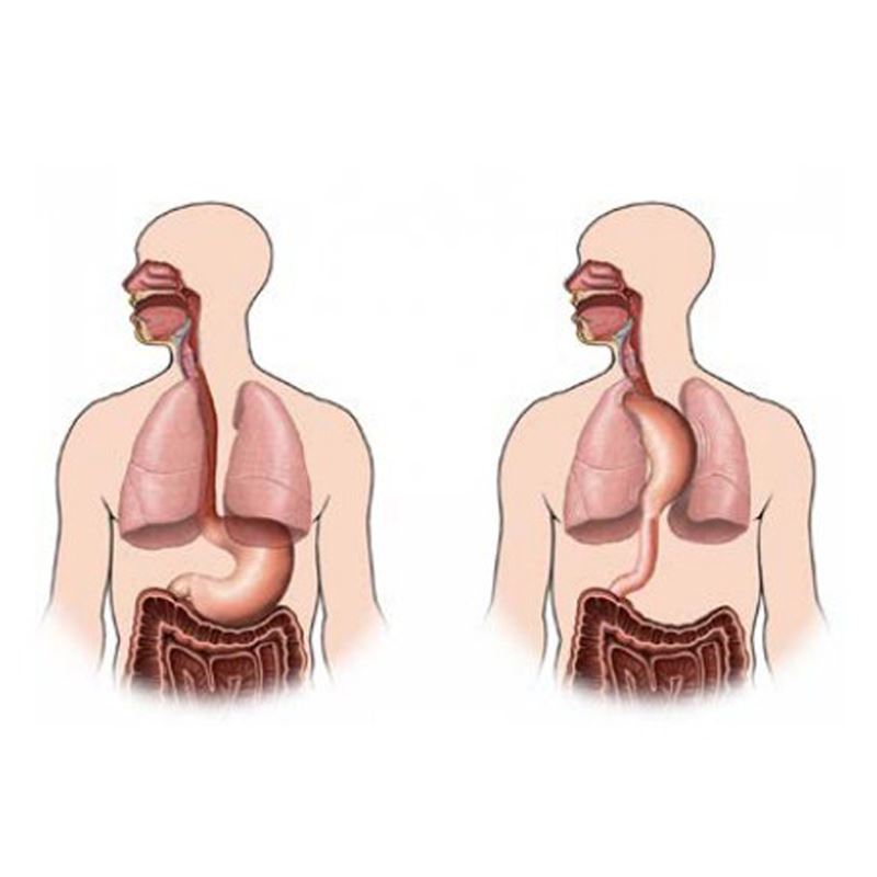 Esophagectomy